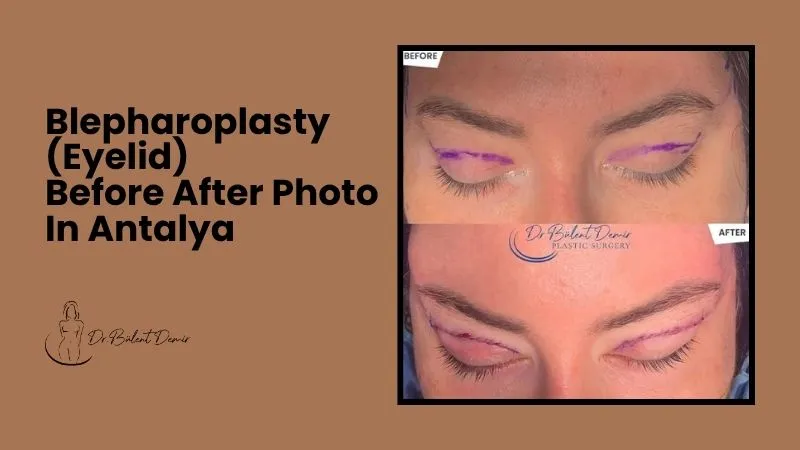 Eyelid before after photo Antalya Turkey